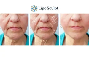 Explaining Morpheus8 And What It Can Do For You 3 Boost your confidence with Morpheus8 Bury St Edmunds call our team today!