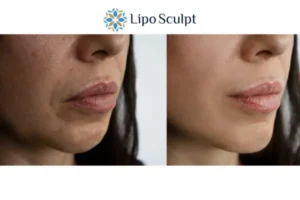 Explaining Morpheus8 And What It Can Do For You 4 Morpheus8 Bury St Edmunds the best results - call our team today!