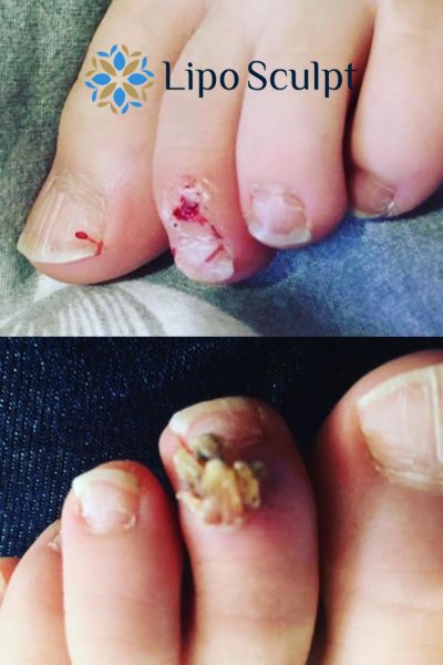 Wart removal customer results from Lipo Sculpt Bury St Edmunds